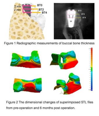  Tricalcium Phosphate: Unveiling its Versatility in Bone Regeneration and Dental Implants!