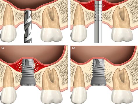 Iodine-Doped Hydroxyapatite: The Wonder Material Revolutionizing Bone Regeneration and Dental Implants?